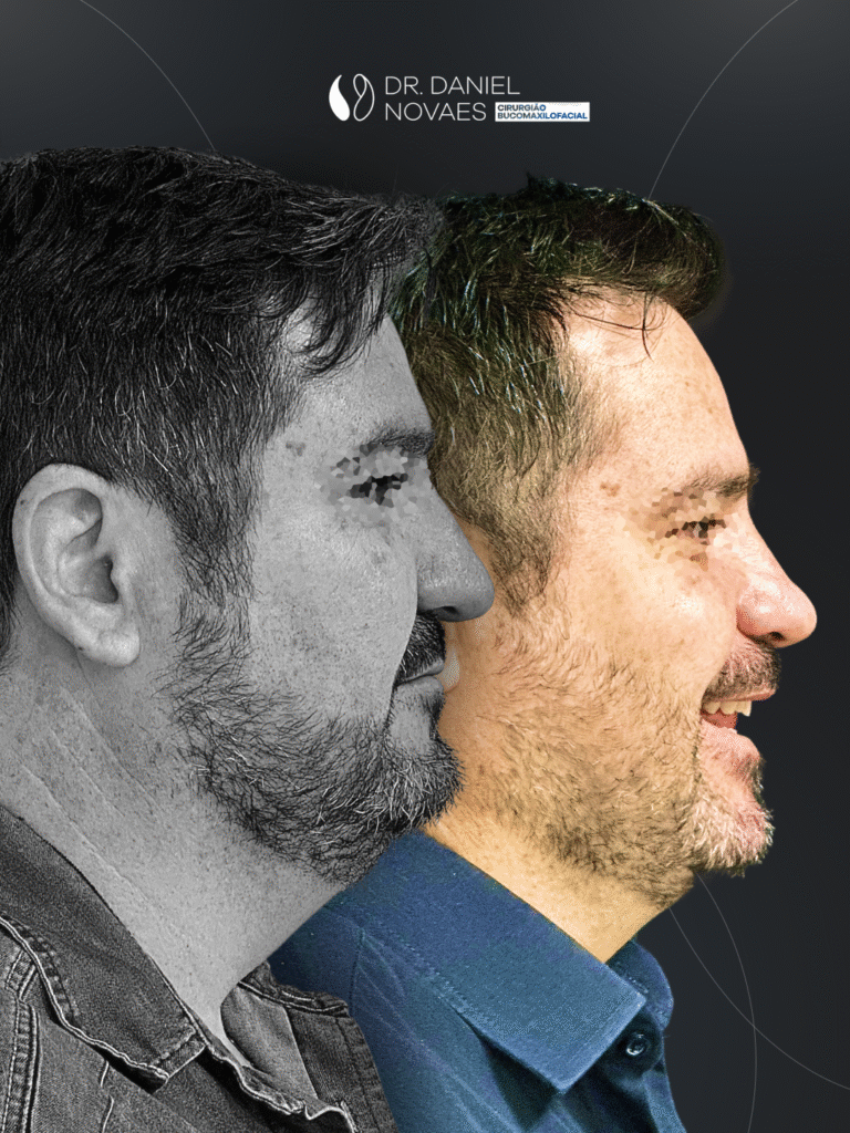 Daniel Novaes - Antes e depois Leonardo