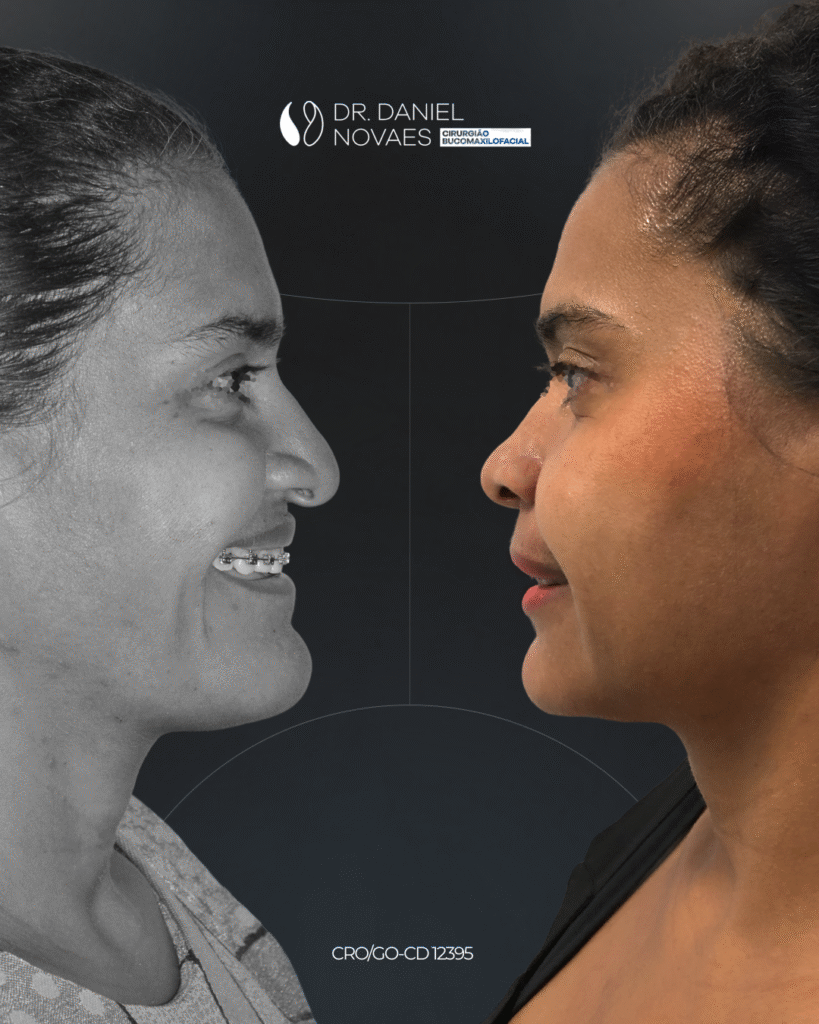 Daniel Novaes - Antes e depois_Francisca