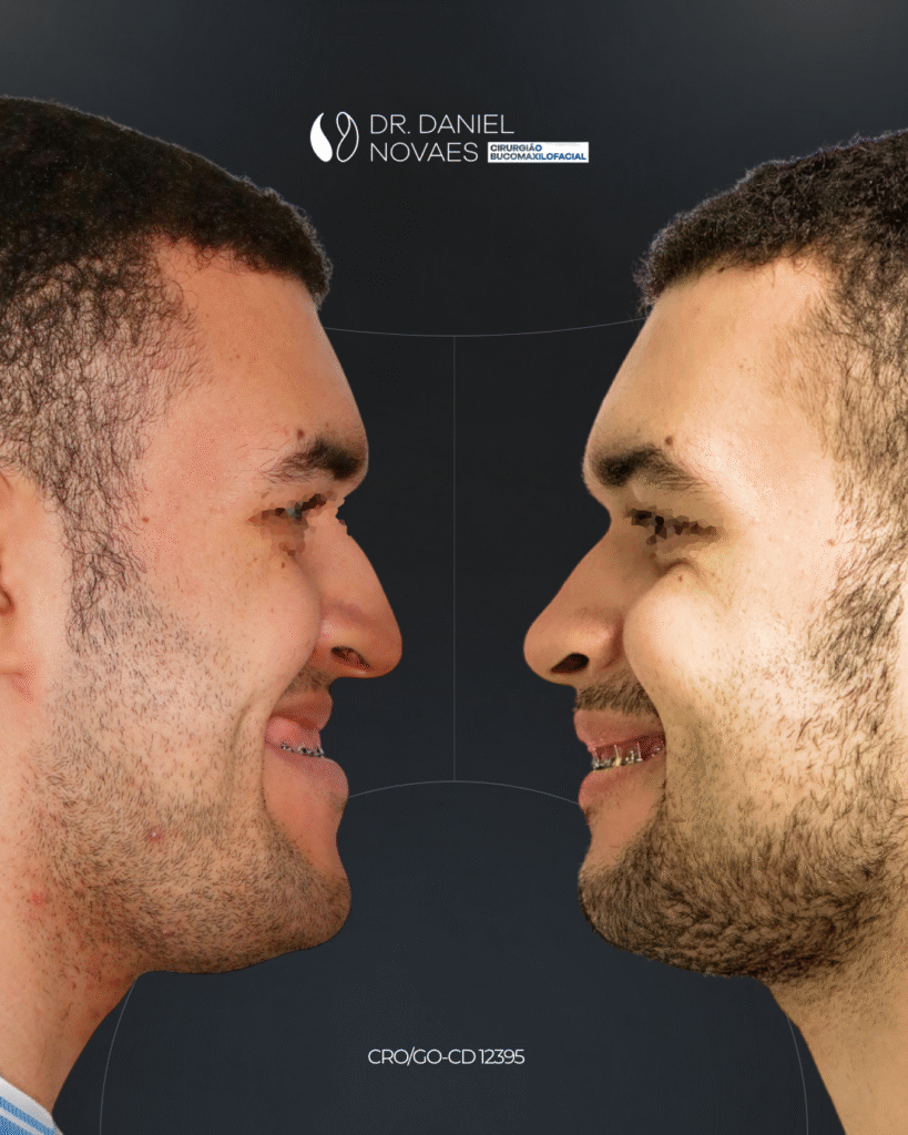 Daniel Novaes - Antes e depois_Yan